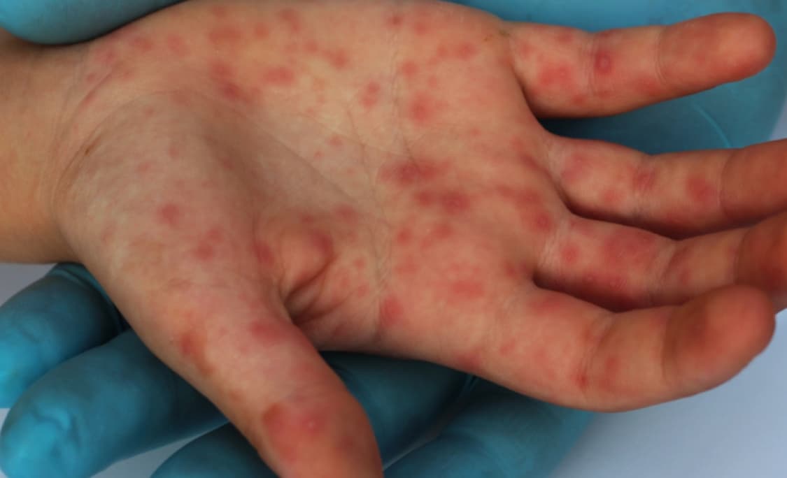 Mais um caso de suspeita de sarampo é investigado