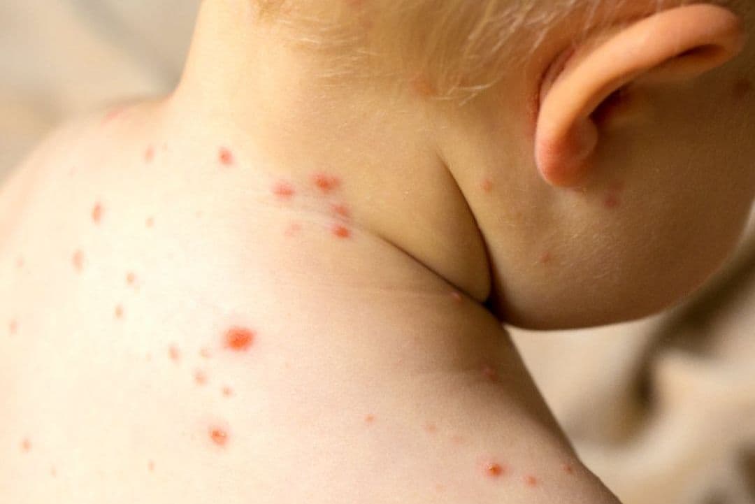 Resultado de reteste de sarampo é esperado para esta quarta (28)