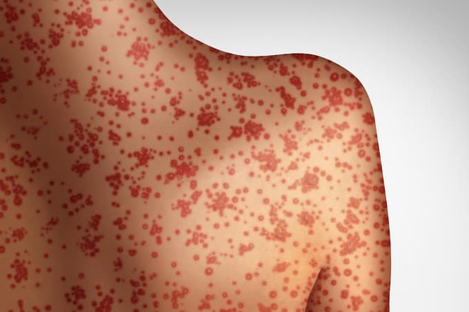 Sarampo e o crescente número de casos no país