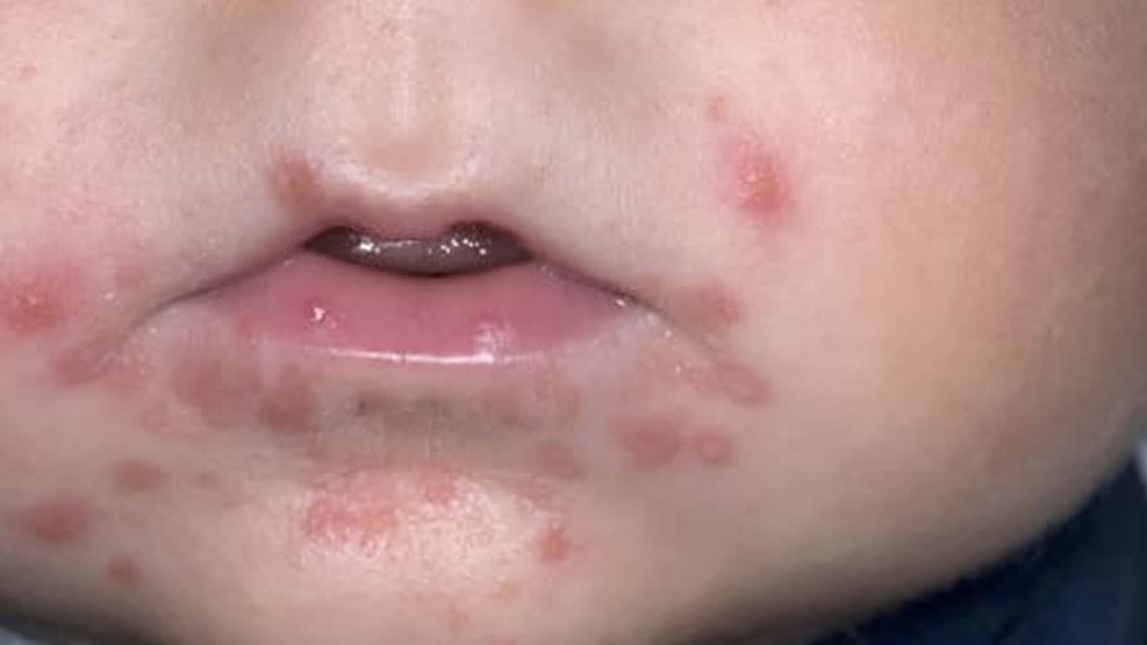 Mão-pé-boca: alerta para os pais!