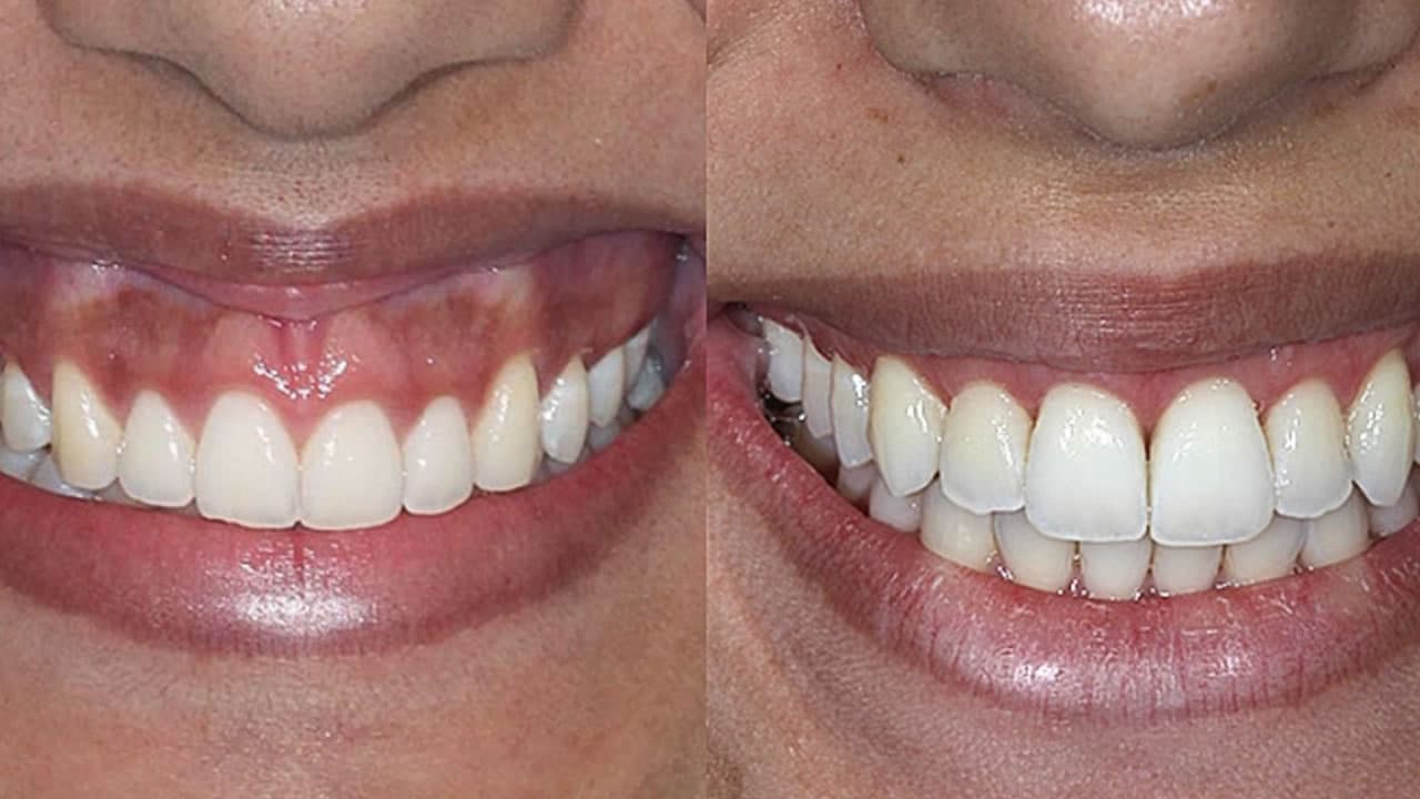 Sorriso Gengival: Muita gengiva e pouco dente?