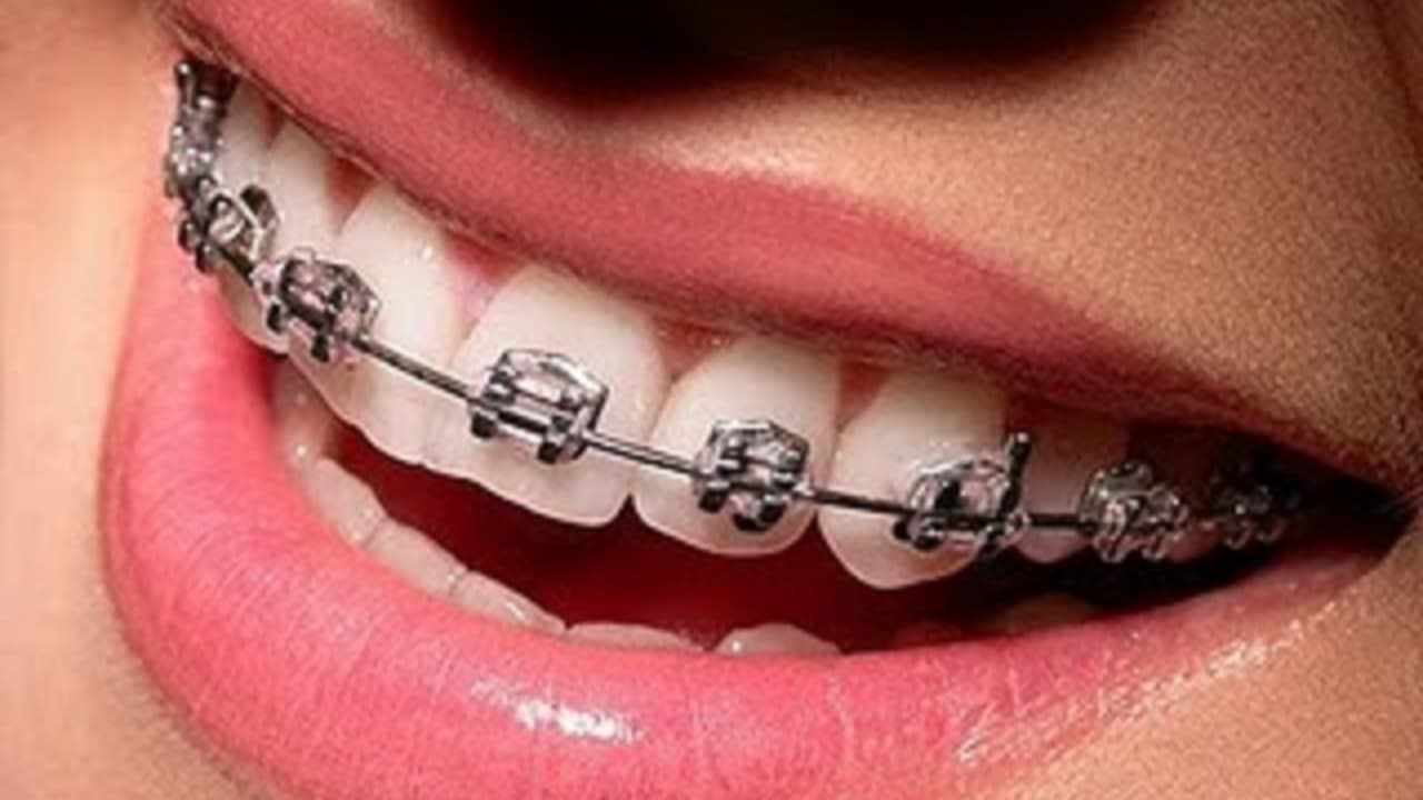 Seu pior inimigo no tratamento ortodôntico é você mesmo!