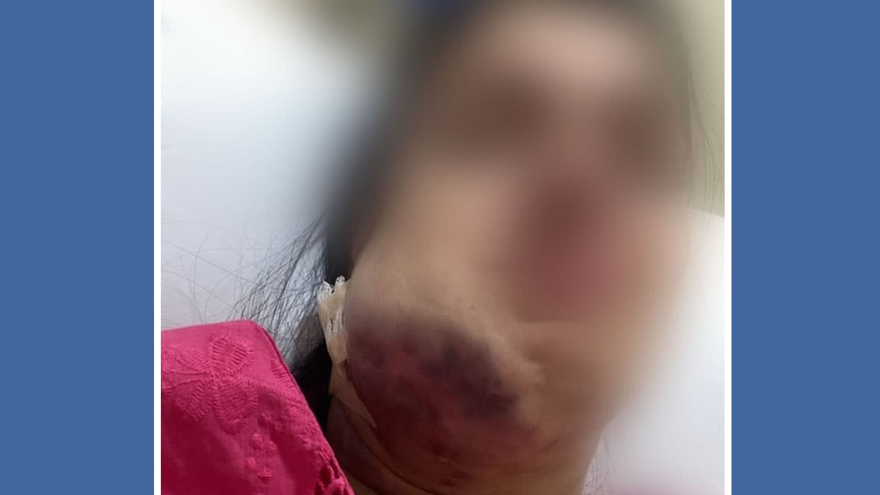 Harmonização facial malsucedida leva paciente à UTI