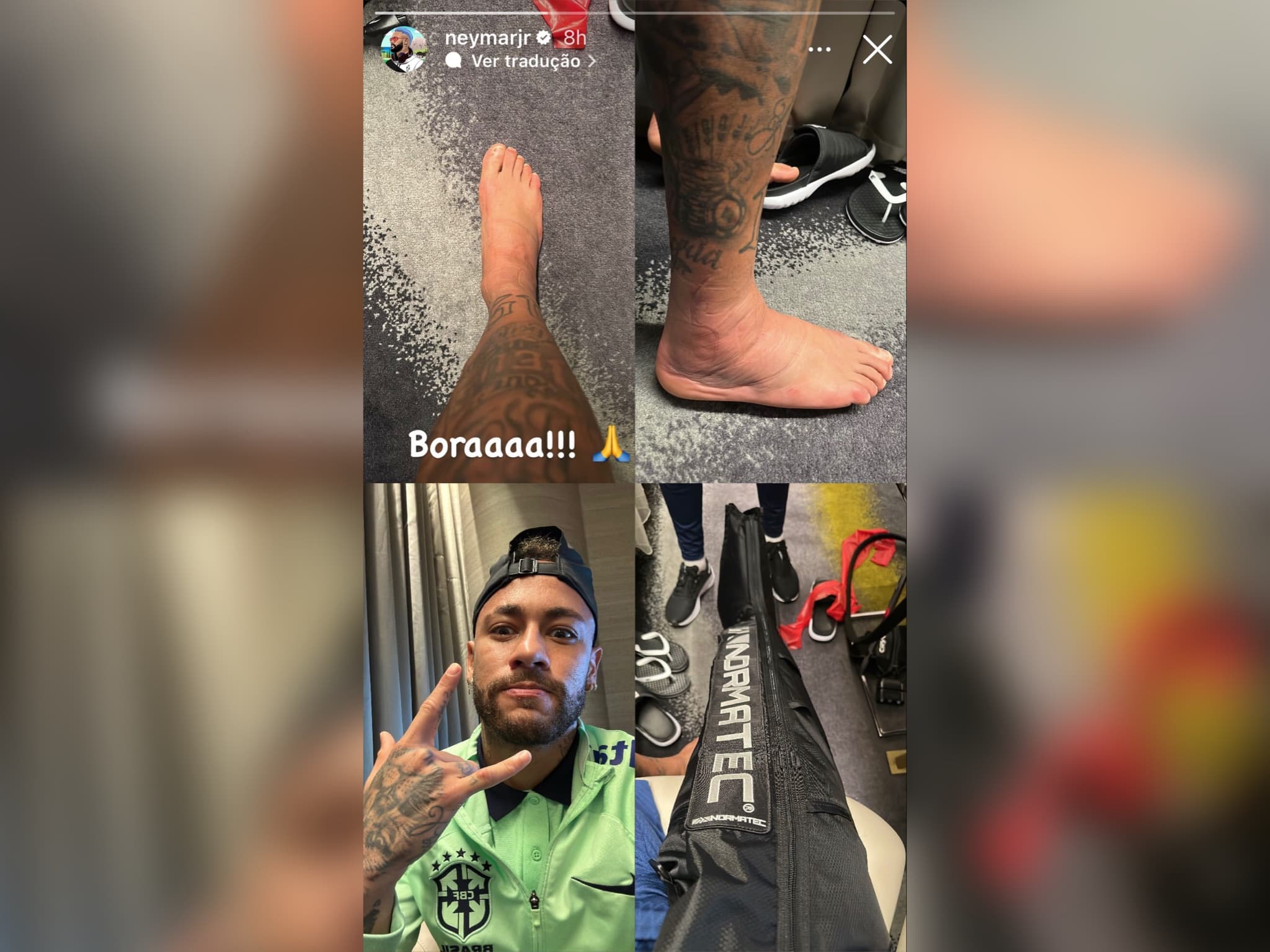 Neymar publica foto de pé inchado em meio a tratamento de lesão no tornozelo