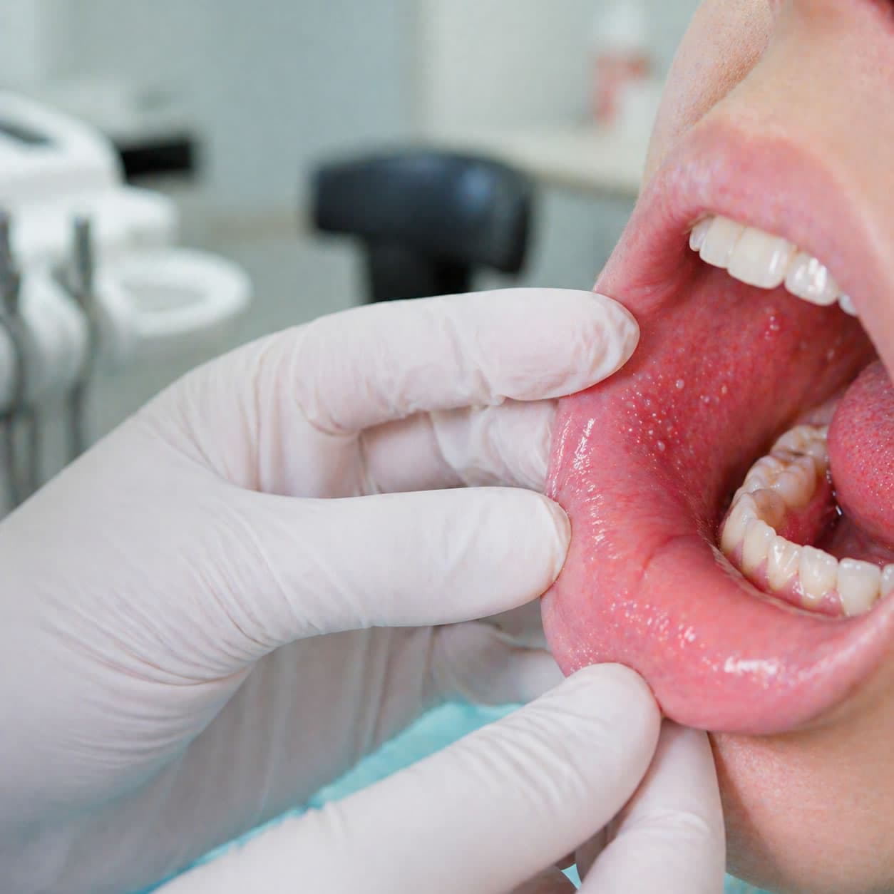 Sarampo: o papel do dentista no diagnóstico