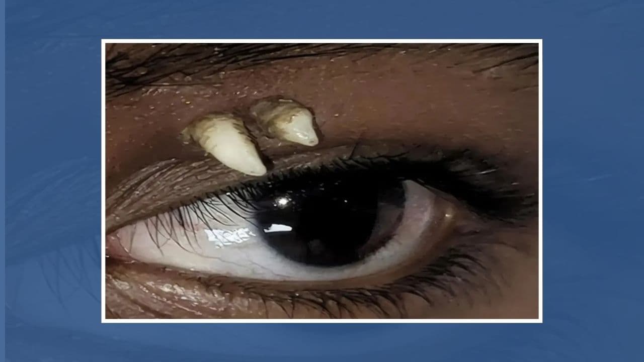 Adolescente descobre dente crescendo acima do olho