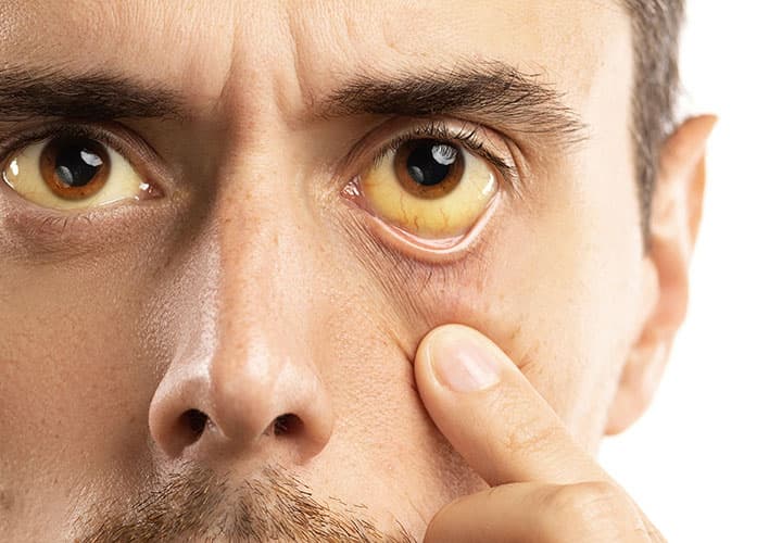 Dia Mundial de Luta Contra Hepatites Virais alerta para cuidados com a patologia