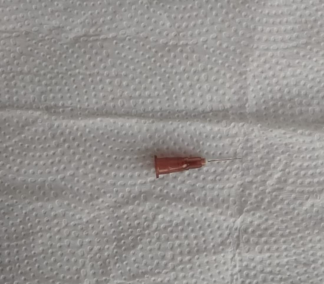 Polícia investiga caso de agulha esquecida em criança em Armazém